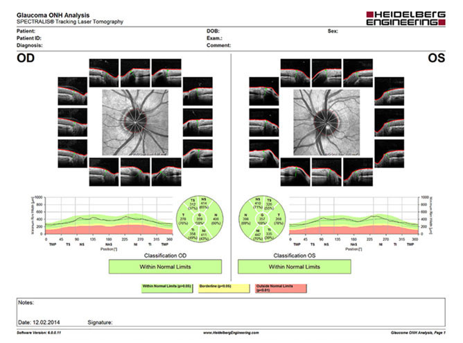 Spectralis OCT: State-of-the-art imaging technology used in our Toowoomba clinic